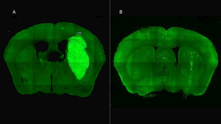 Investigadores del CONICET descubrieron un método innovador para frenar un tipo de tumor cerebral agresivo